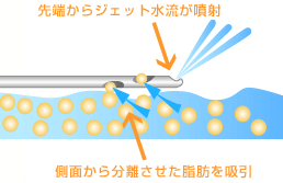 体外式超音波吸引法