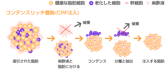 コンデンスリッチ豊胸(CRF注入)