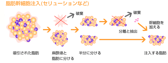 脂肪幹細胞注入(セリューションなど)