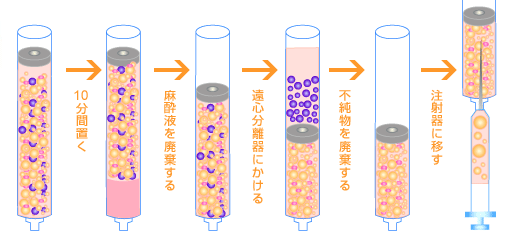 脂肪の採取から注入まで