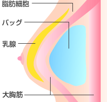 大胸筋下法