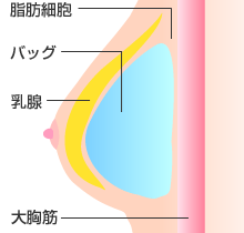 乳腺下法