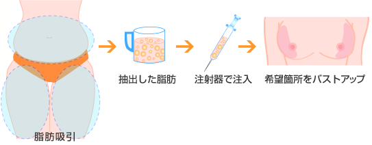 脂肪吸引から注入までの流れ